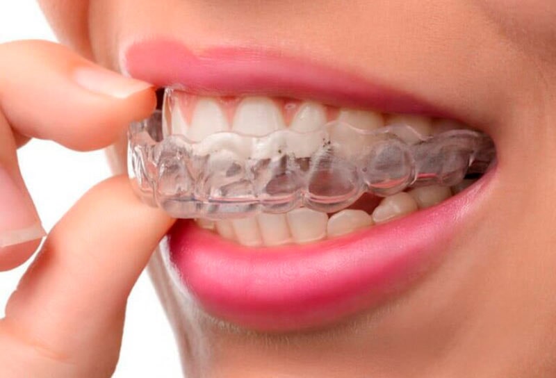 faccette dentali Studio Machetti Centro Odontoiatrico