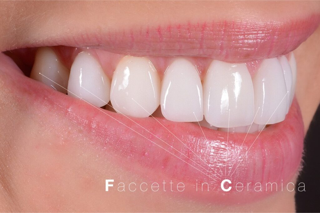 faccette dentali Studio Machetti Centro Odontoiatrico